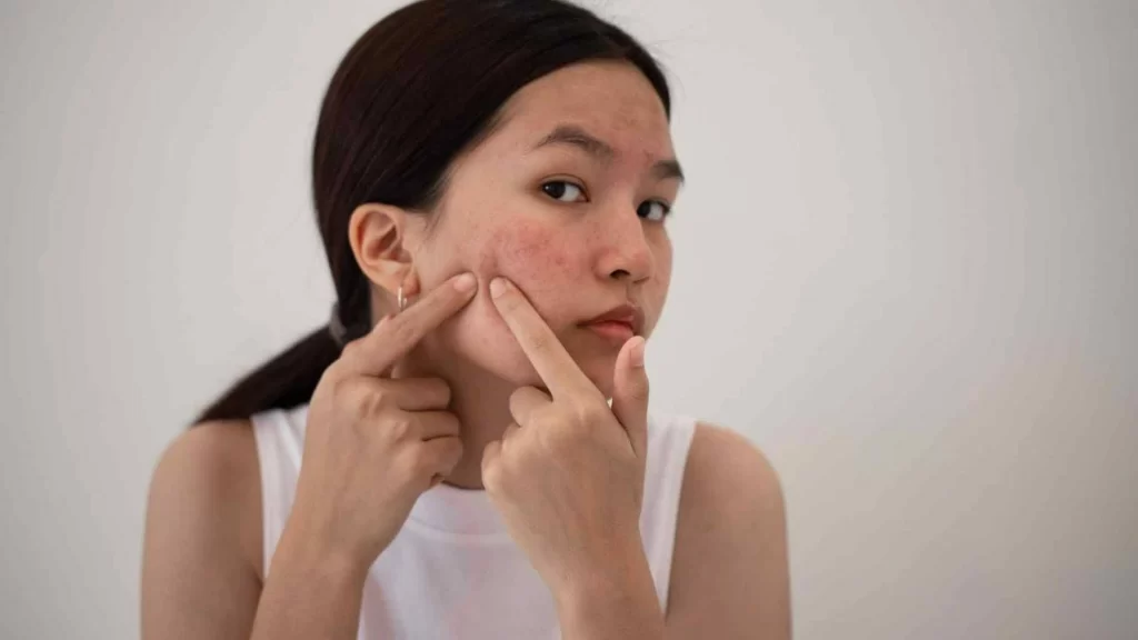 Breaking Free from the Cycle of Cystic Acne: Tips from MakatiMed