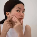 Breaking Free from the Cycle of Cystic Acne: Tips from MakatiMed